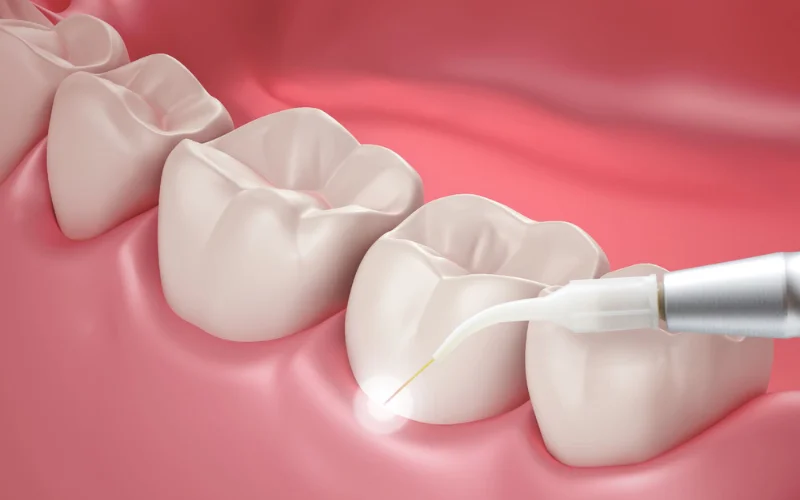 Periodontologinis gydymas